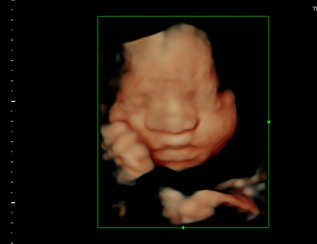 3D ultrasound image at 29 weeks